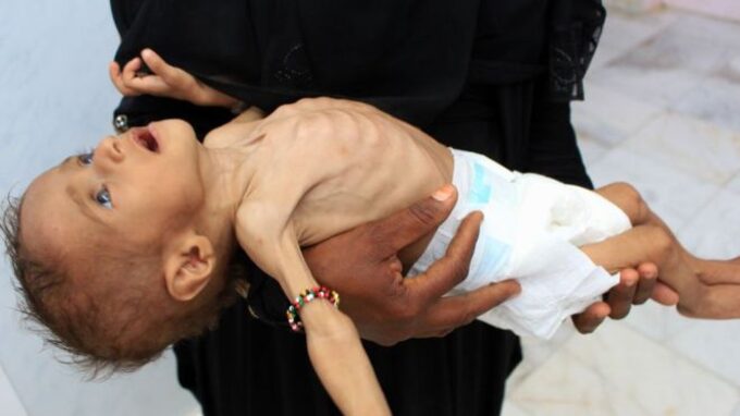yemende_acliktan_85_bin_cocuk_oldu.jpg